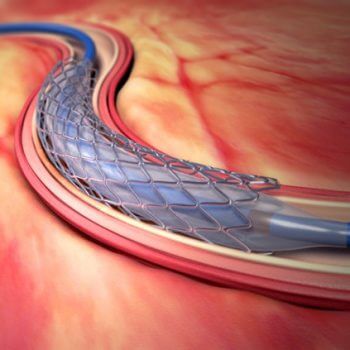 stent stent